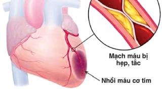 Nitroglycerin trong điều trị bệnh tim mạch, những điều cần biết